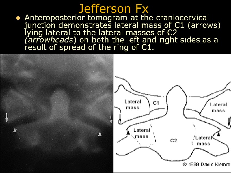 Jefferson Fx Anteroposterior tomogram at the craniocervical junction demonstrates lateral mass of C1 (arrows)